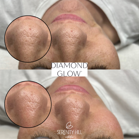 Diamond Glow Facial 12 (1)