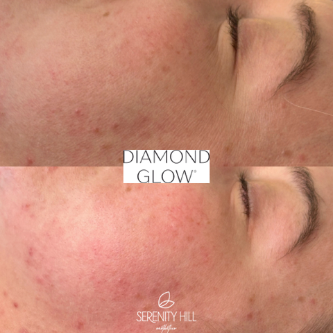 Diamond Glow Facial 5