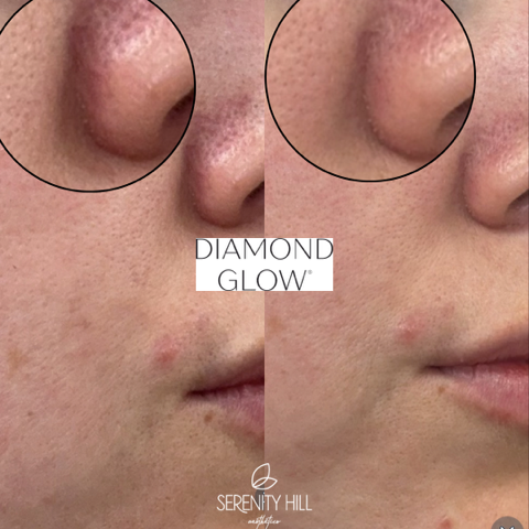 Diamond Glow Facial 7