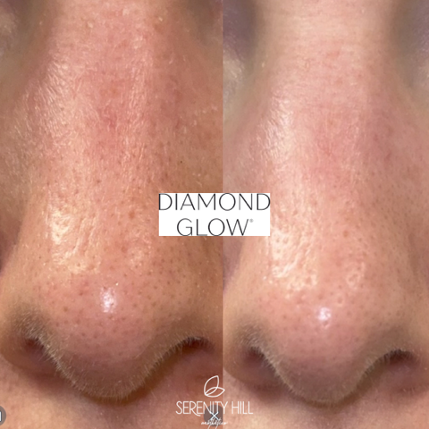 Diamond Glow Facial 8