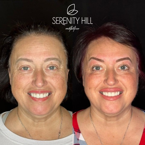 Full Face Correction 1