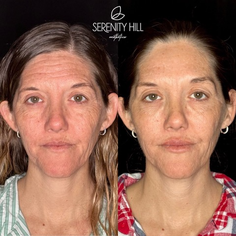 Full Face Correction 11