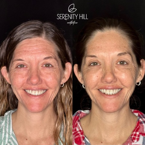 Full Face Correction 12