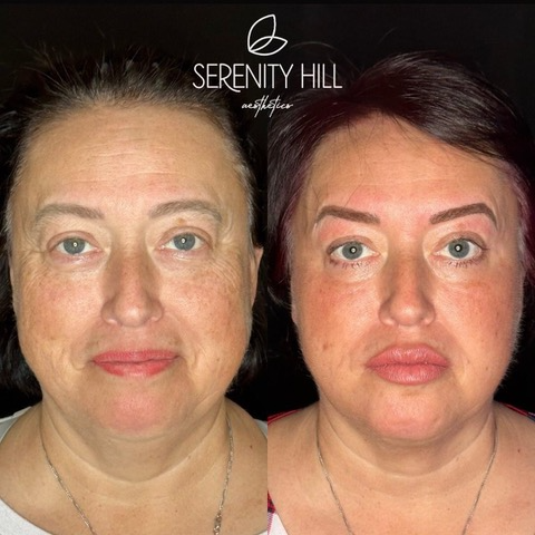 Full Face Correction 2