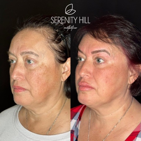 Full Face Correction 3