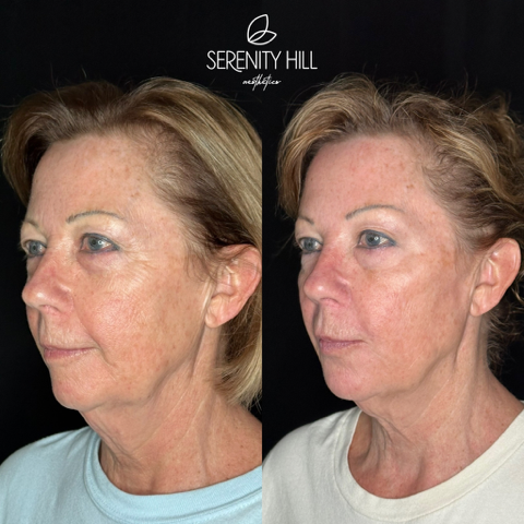 Full Face Correction 7