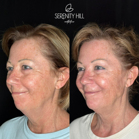 Full Face Correction 8