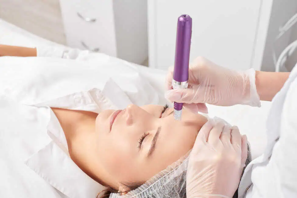 Microneedling Pen by Serenity Hill Aesthetics in Wichita Falls, TX