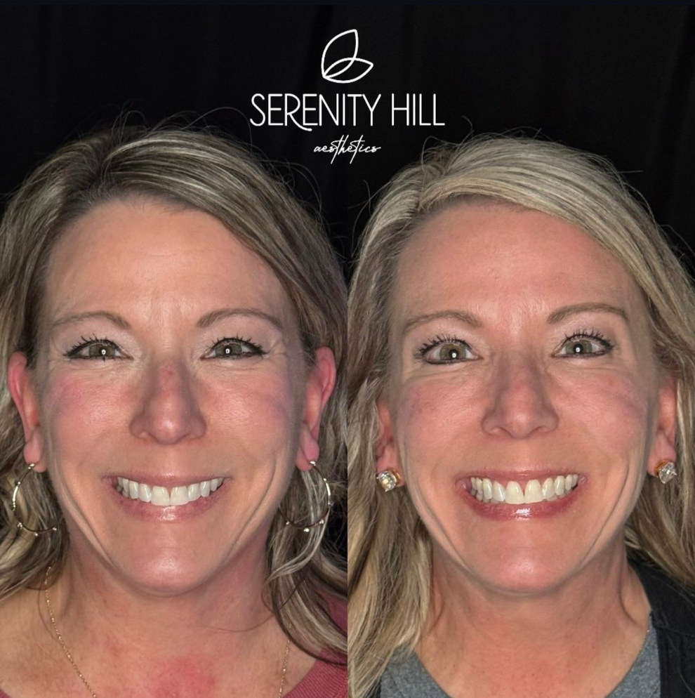 Before and after wrinkle relaxing results showing smoother, youthful skin.
