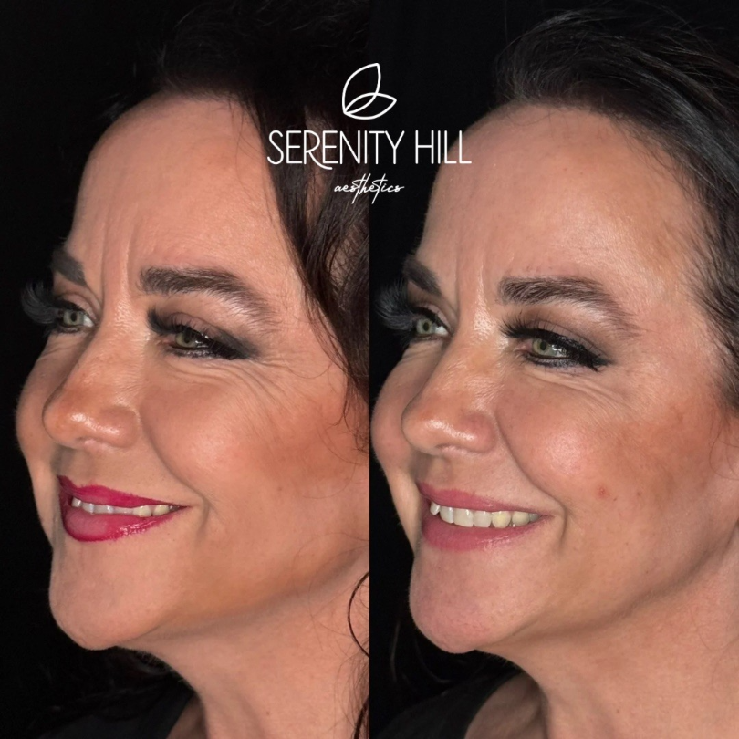 Botox Before and after results on the forehead and upper face.