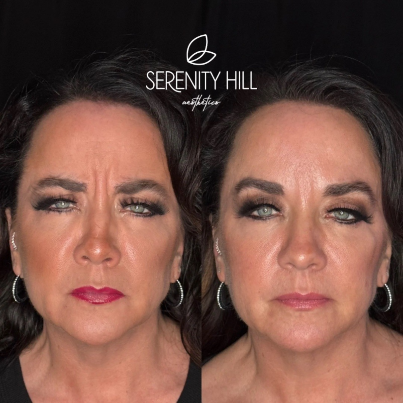 Before and after results of wrinkle reduction treatment on the forehead and upper face.