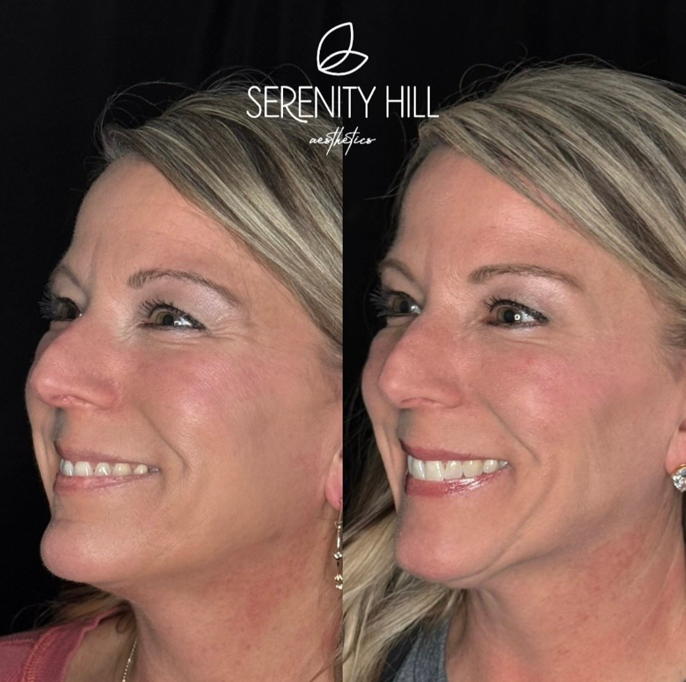 Before and after wrinkle reduction results showing smoother, more youthful skin.