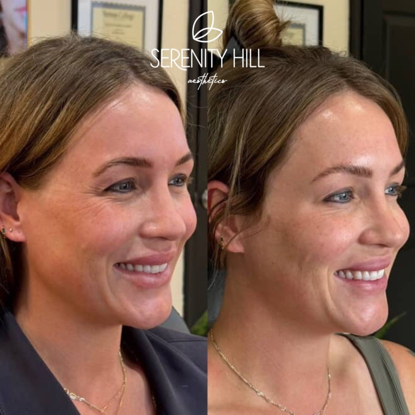 Before and after wrinkle reduction results with smoother, rejuvenated skin.