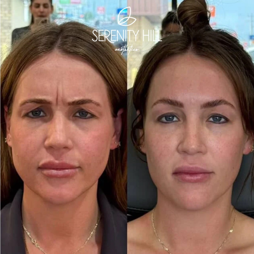 Before and after results of wrinkle reduction treatment showing smoother and youthful skin.