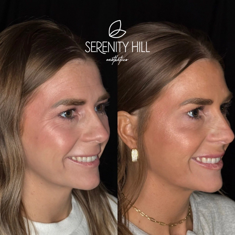 Before and after wrinkle reduction results showing smoother, younger-looking skin.
