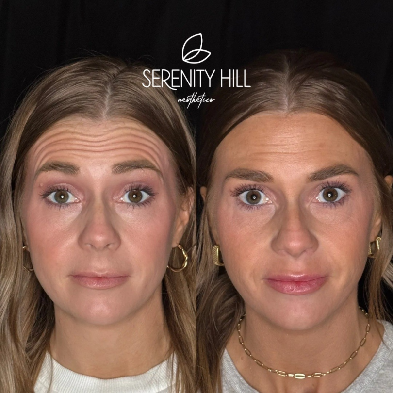 Before and after wrinkle reduction results showing smoother forehead and upper face.