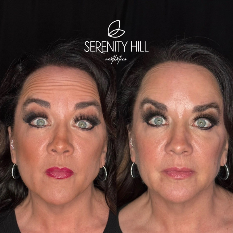 Before and after wrinkle reduction results on the forehead and upper face area.
