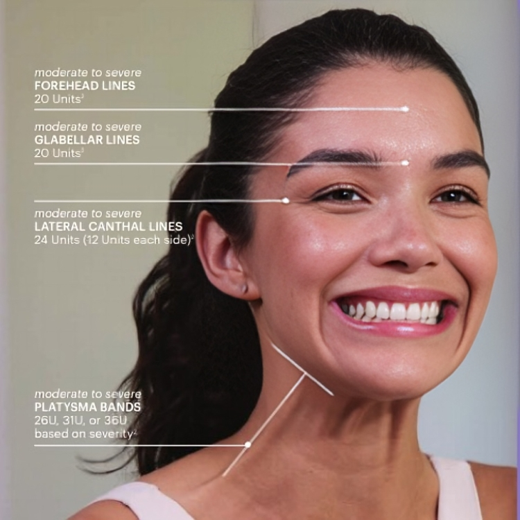 Diagram showing FDA-approved Botox treatment areas and recommended unit amounts for lines and bands.