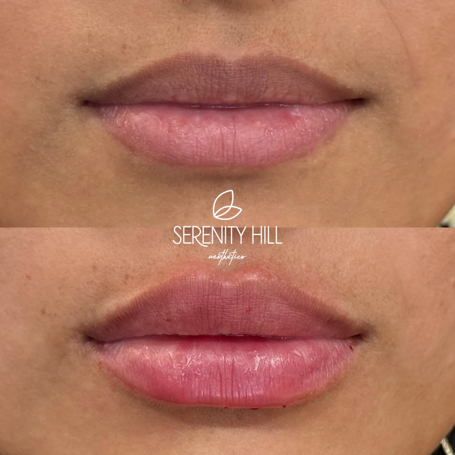 Lip fillers Before and After treatment images