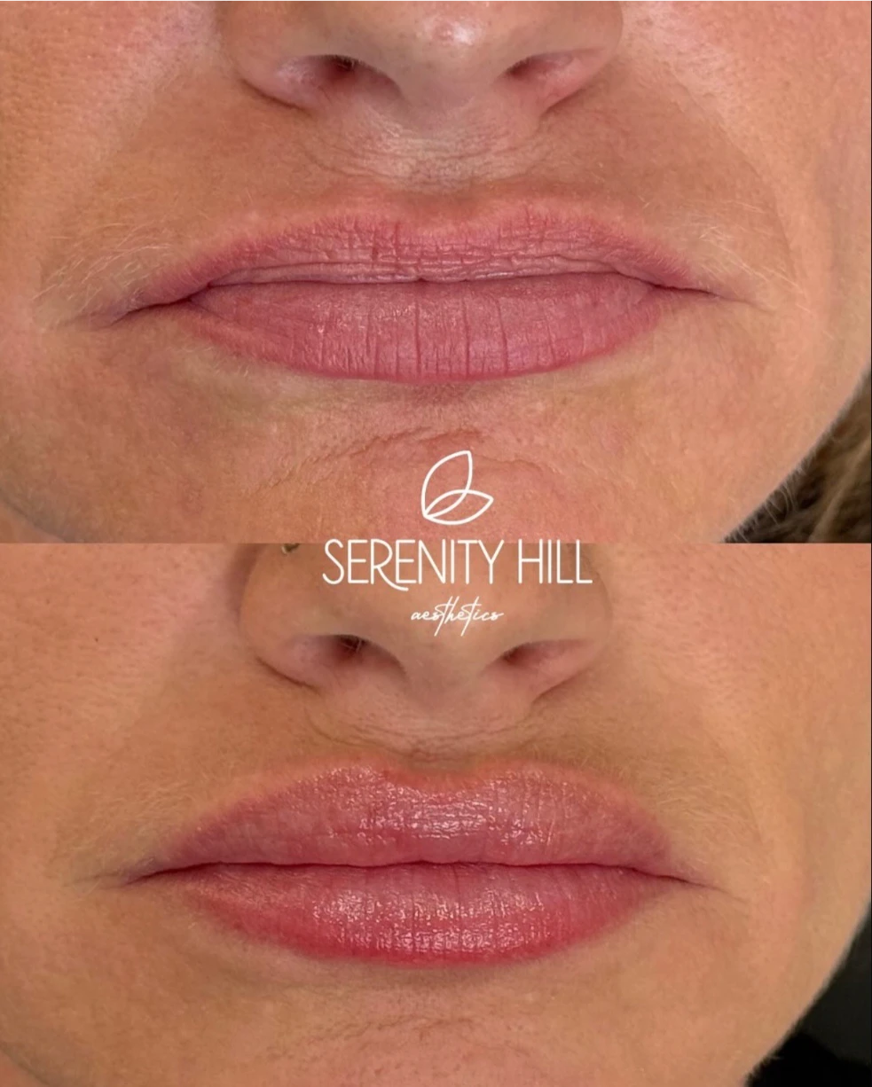 Before and after lip filler results showing enhanced lip volume and shape.