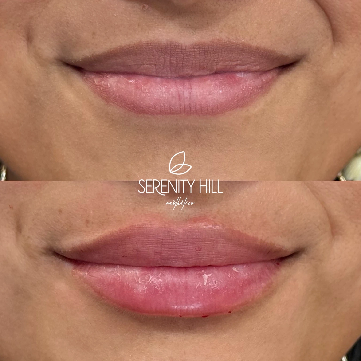 Lip Fillers | before and after treatment results