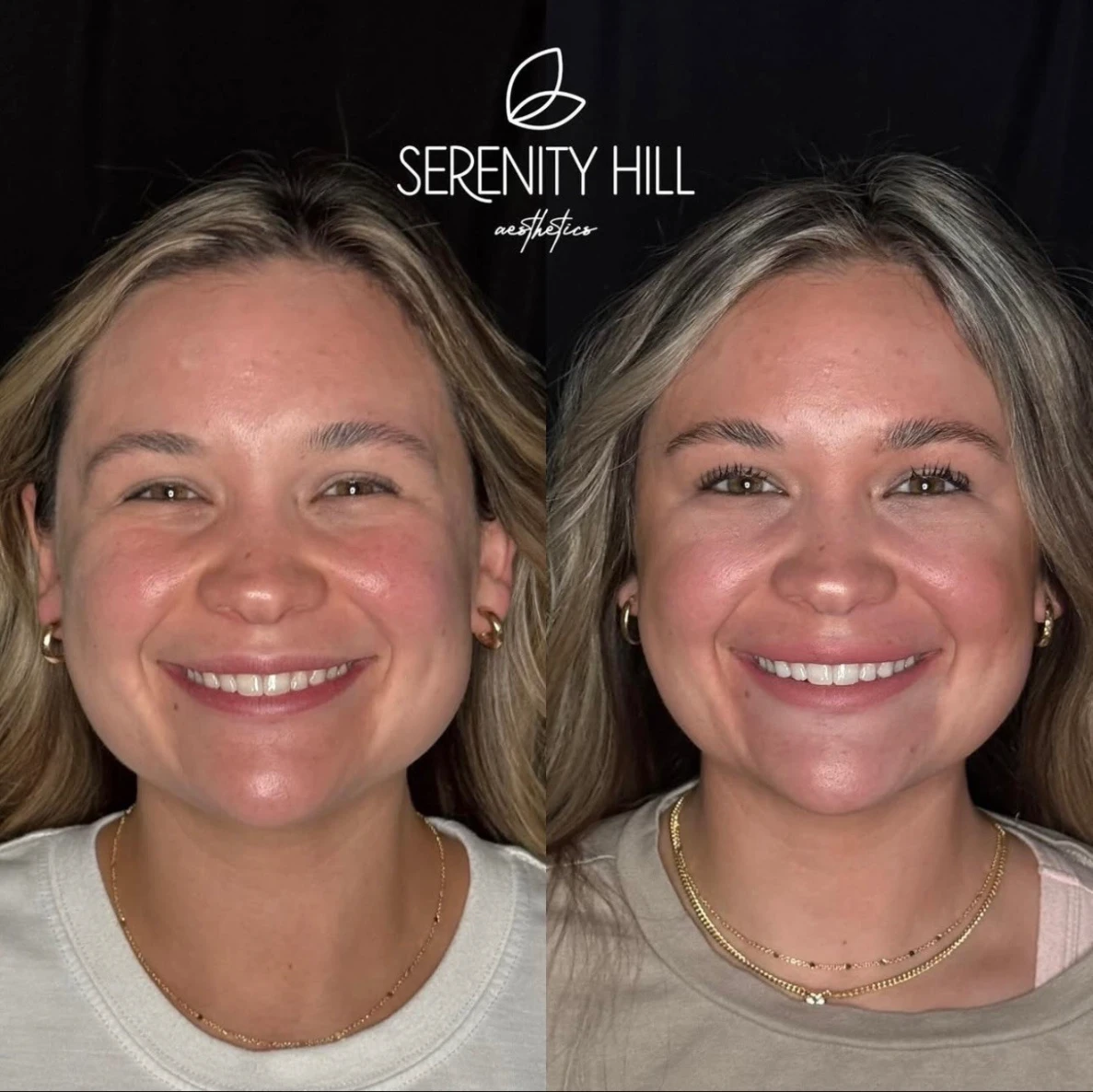 Before and after masseter treatment results