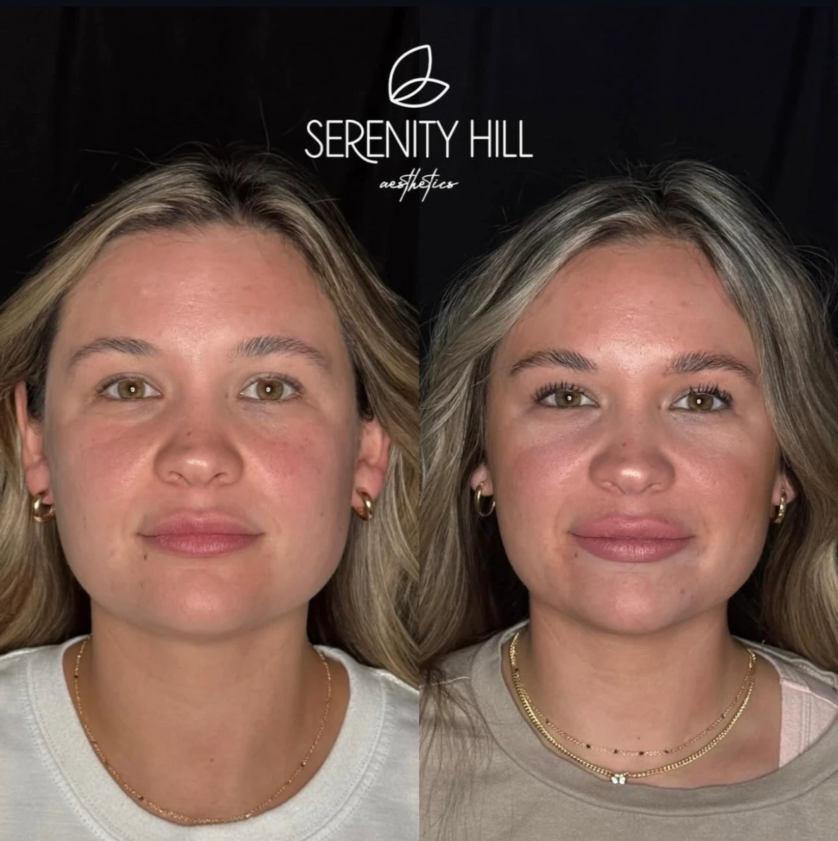 Before and after masseter treatment results showing a more defined jawline.