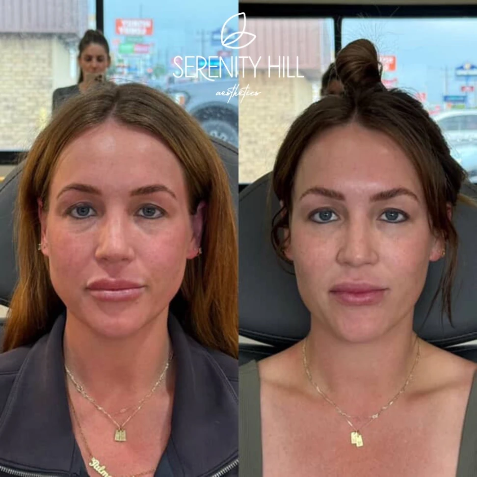 Before and after masseter reduction treatment results | showing a slimmer jawline and facial contour.