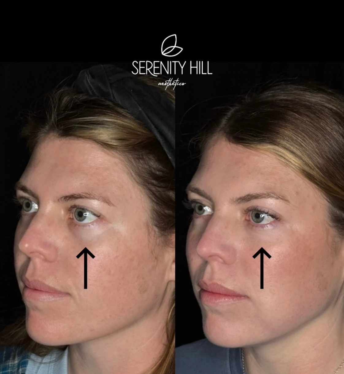 Midface filler before and after results at Serenity Hill Aesthetics highlighting enhanced cheek volume and facial contour.