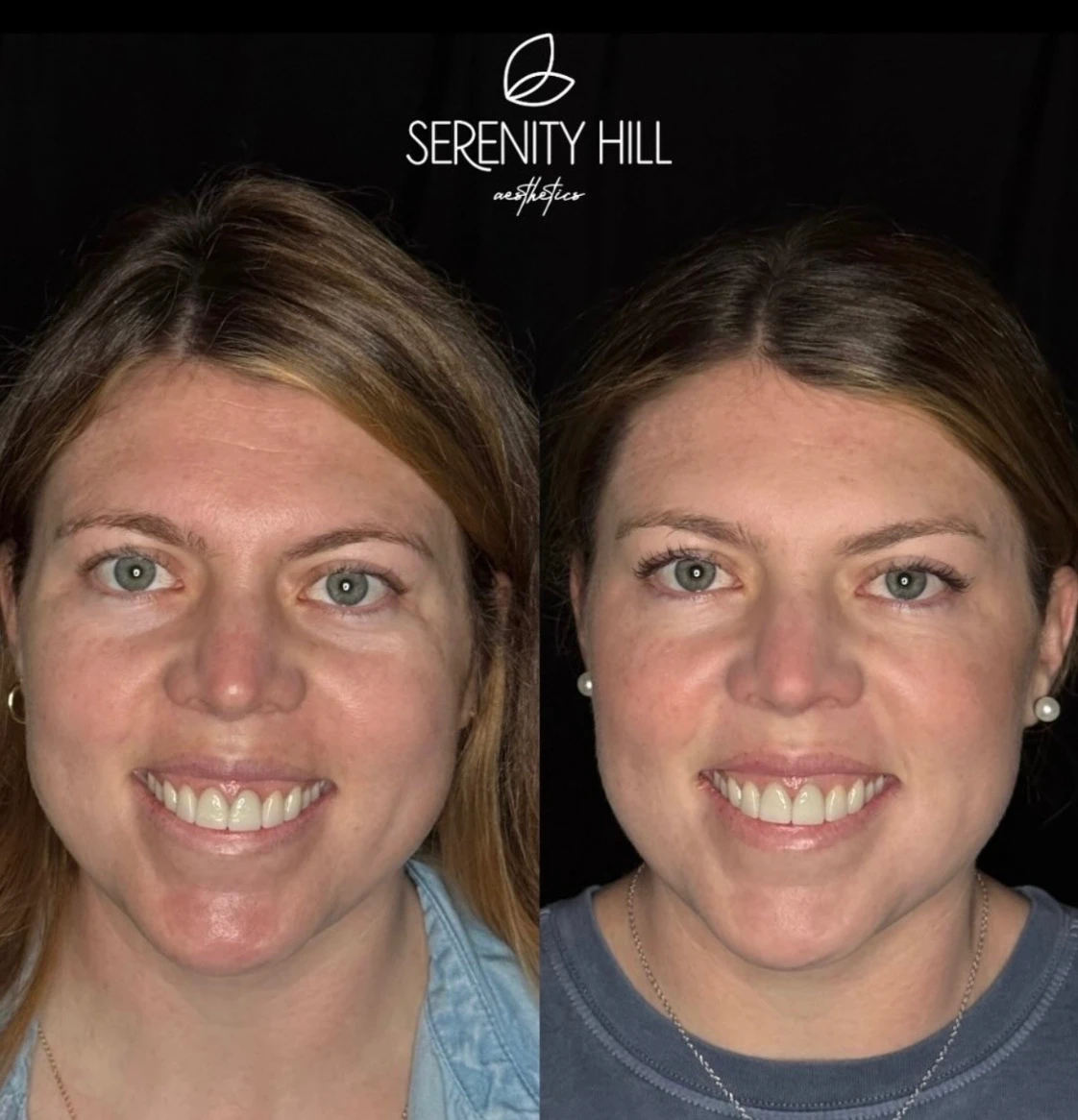 Before and after aesthetic treatment results at Serenity Hill Aesthetics
