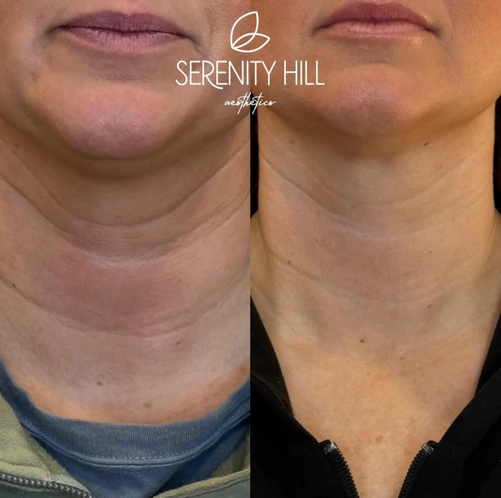 Before and after neck treatment results | Showing smoother and firmer skin.