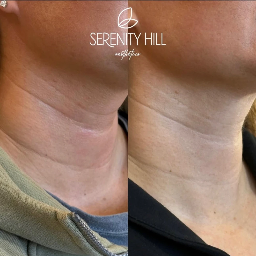 Skinvive neck treatment before and after at Serenity Hill Aesthetics.