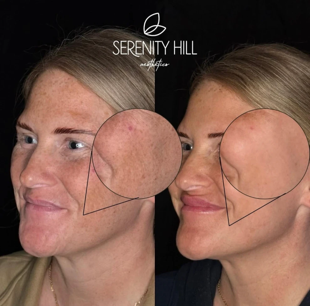Before and After Gallery | Skinvive treatment