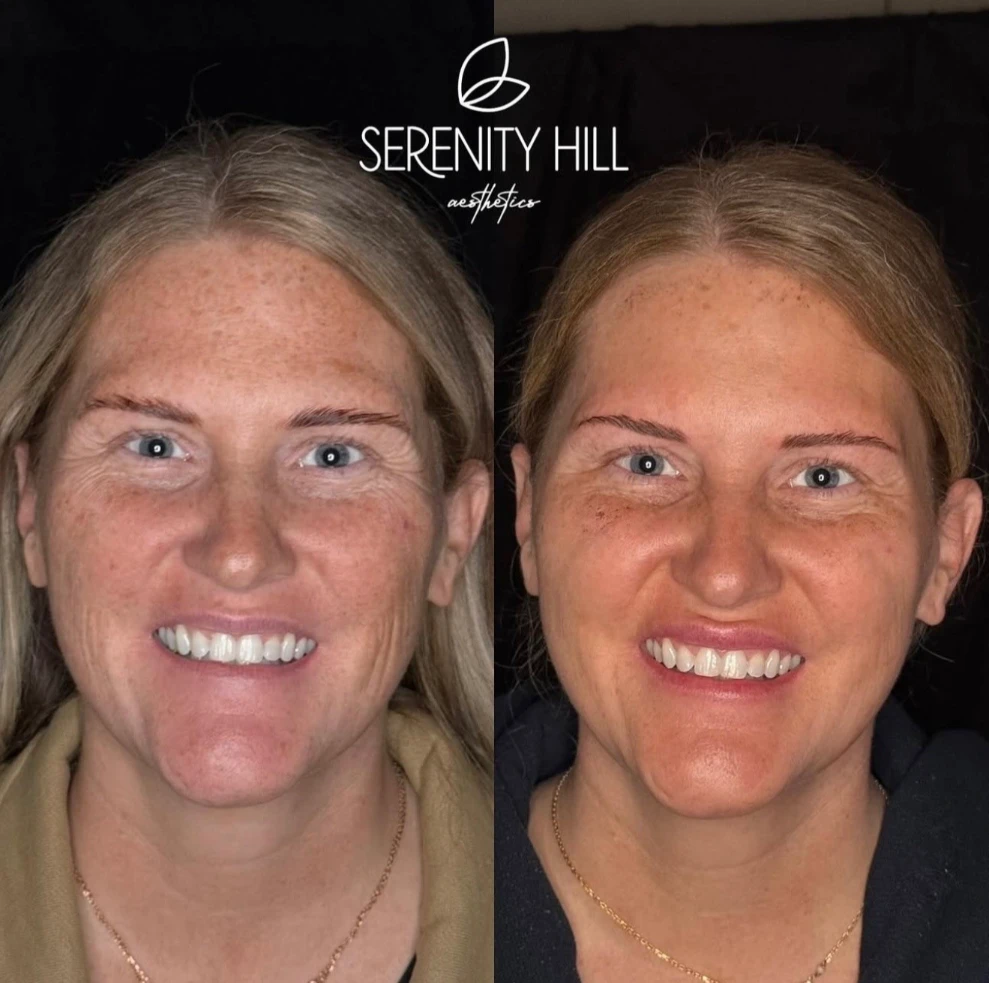 Skinvive treatment before and after results at Serenity Hill Aesthetics.