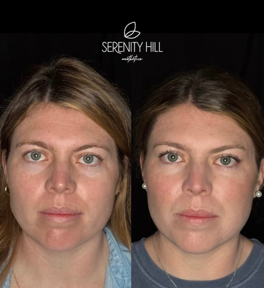 Midface-Filler_2-17-Sept